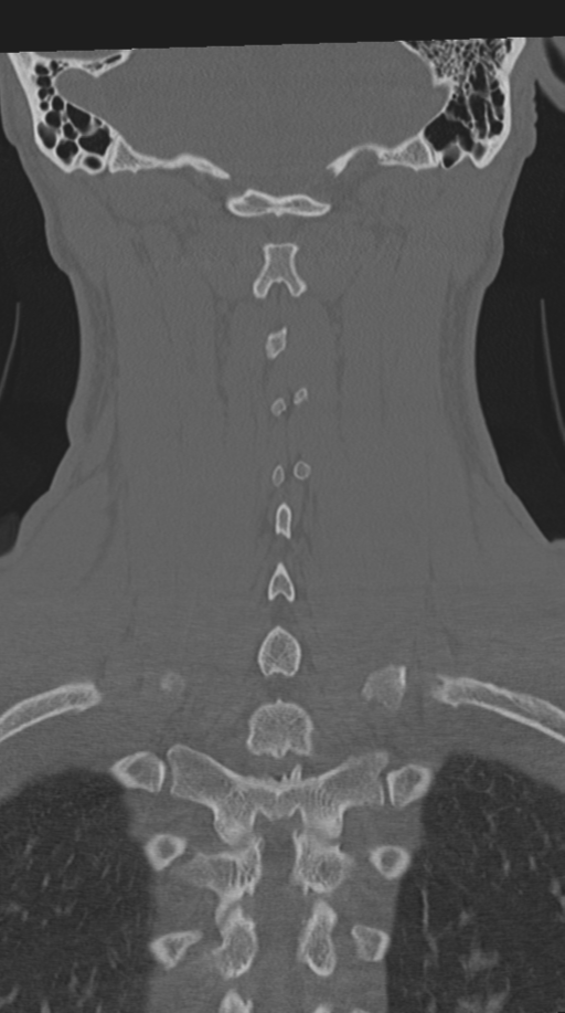 Cervical intercalary bone (Radiopaedia 35211-36748 Coronal bone window 57).png