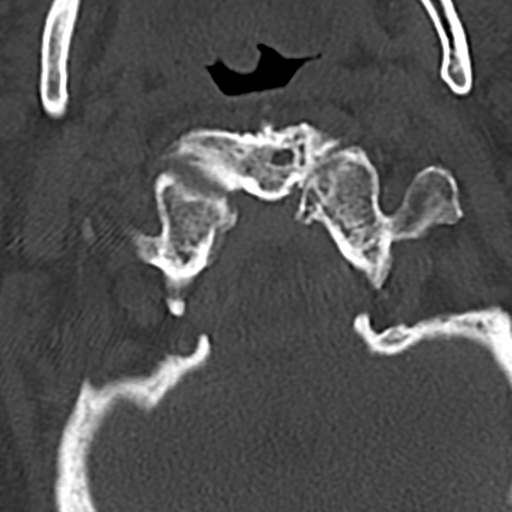 File:Cervical spine fracture - chalk stick (Radiopaedia 39116-41323 Axial bone window 17).png