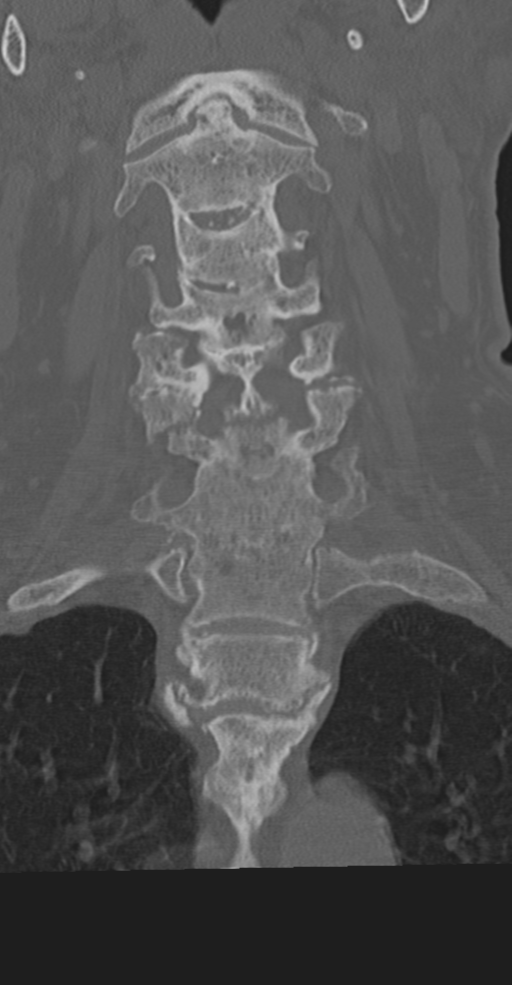 Cervical spine fracture in the setting of ankylosis (Radiopaedia 37038-38715 Coronal bone window 31).png