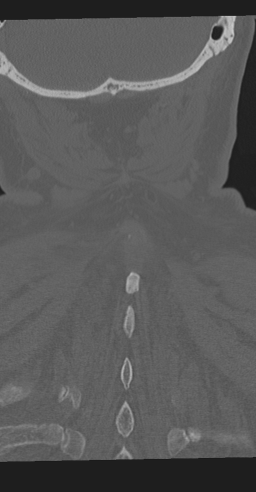 Cervical spine fracture in the setting of ankylosis (Radiopaedia 37038-38715 Coronal bone window 64).png
