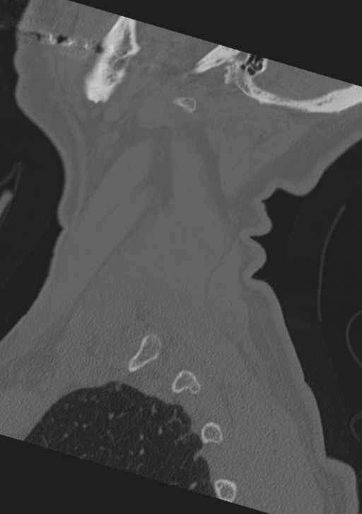 Cervical spine fractures with vertebral artery dissection (Radiopaedia 53296-59268 Sagittal bone window 64).png
