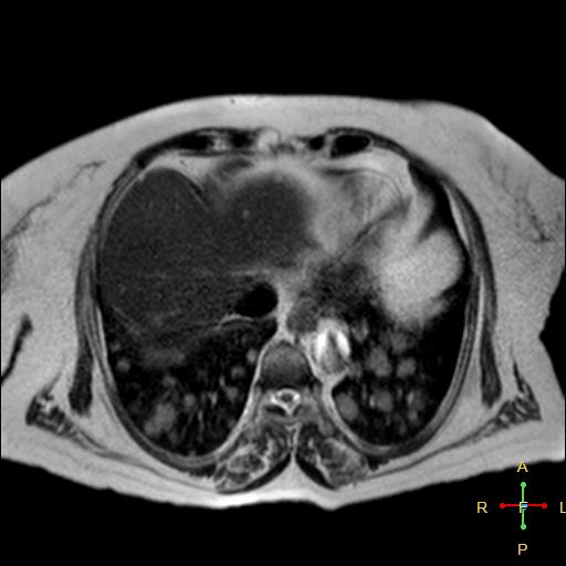 File:Cervical stump squamous cell carcinoma (Radiopaedia 48049-52858 I 19).jpg