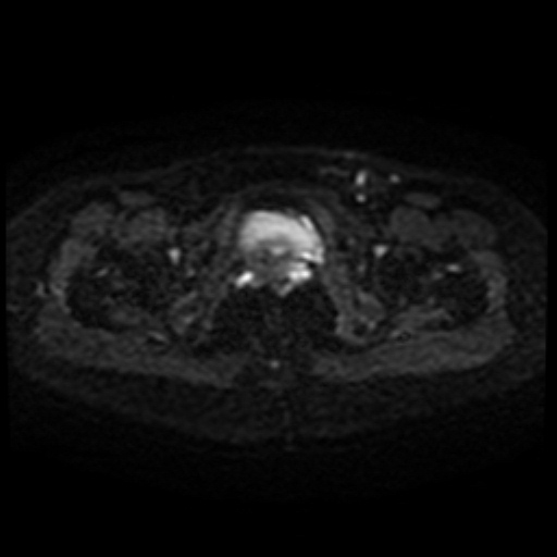Cesarian section scar endometriosis (Radiopaedia 66520-75799 Axial DWI 46).jpg