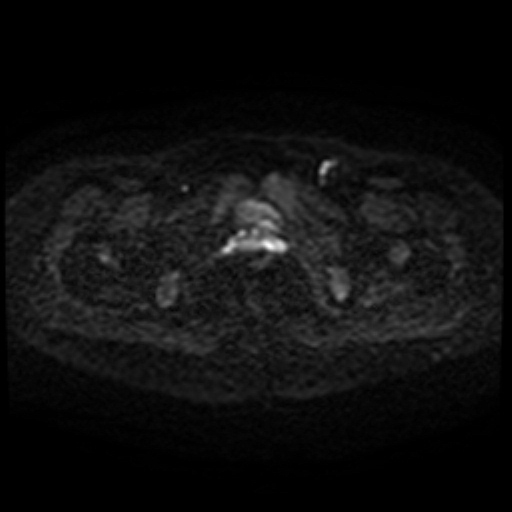 File:Cesarian section scar endometriosis (Radiopaedia 66520-75799 Axial DWI 72).jpg