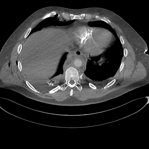 File:Chest multitrauma - aortic injury (Radiopaedia 34708-36147 A 225).png