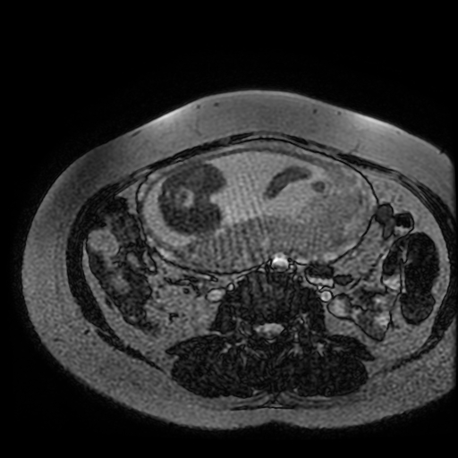Chiari II malformation - fetal MRI (Radiopaedia 68099-77581 Axial Fiesta 4).jpg