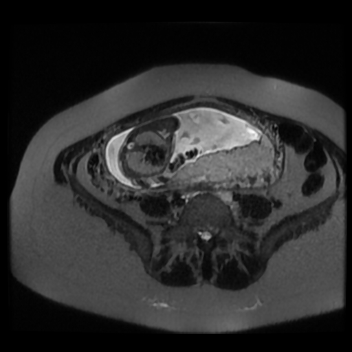 Chiari II malformation - fetal MRI (Radiopaedia 68099-77581 Axial T2-SSFSE 27).jpg