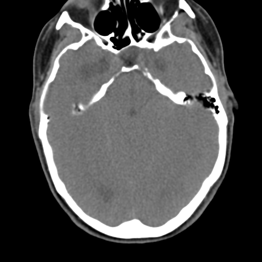 File:Chiari I malformation and obstructive hydrocephalus (Radiopaedia 41185-43981 D 19).png