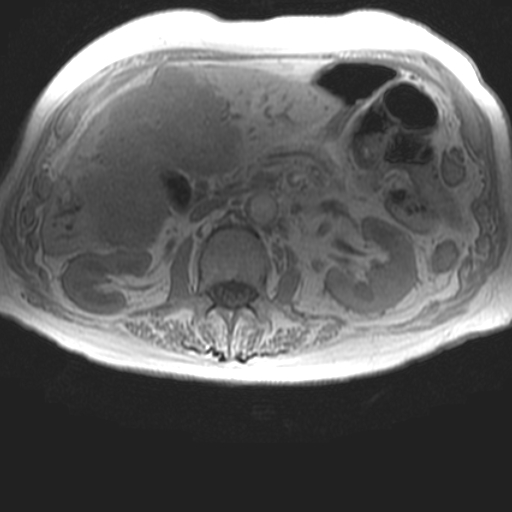File:Cholangiocarcinoma - mass-forming pattern (Radiopaedia 16017-15677 T1 in-phase 19).jpg