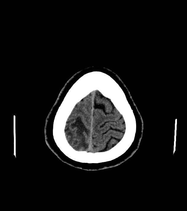 Cholangiocarcinoma with cerebral metastases (Radiopaedia 83519-98628 Axial non-contrast 58).jpg