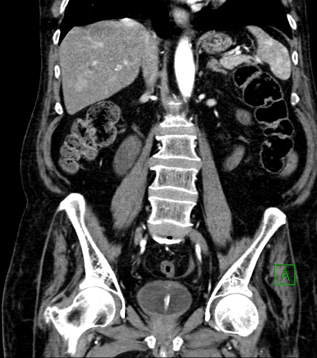 Cholangiocarcinoma with cerebral metastases (Radiopaedia 83519-98629 E 52).jpg