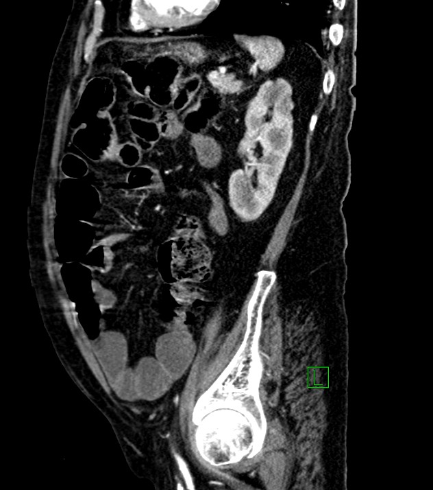 Cholangiocarcinoma with cerebral metastases (Radiopaedia 83519-98629 F 38).jpg