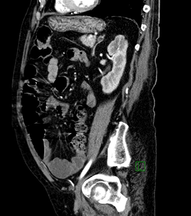 Cholangiocarcinoma with cerebral metastases (Radiopaedia 83519-98629 F 44).jpg