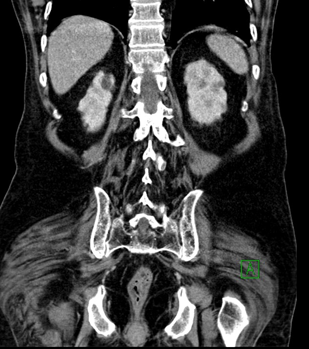 Cholangiocarcinoma with cerebral metastases (Radiopaedia 83519-98629 G 63).jpg