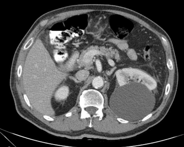 Cholecystitis - perforated gallbladder (Radiopaedia 57038-63916 A 31).jpg