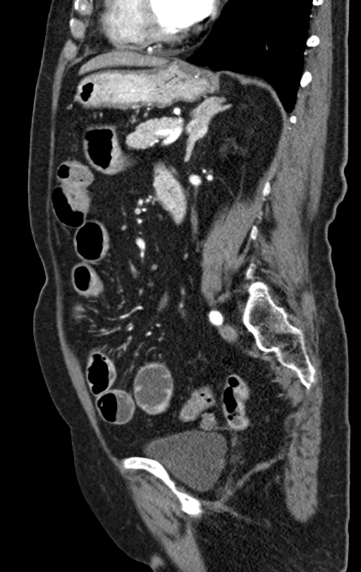 Cholecystoduodenal fistula due to calculous cholecystitis with gallstone migration (Radiopaedia 86875-103077 C 25).jpg