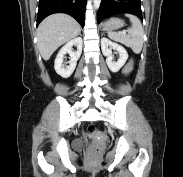 Choledocholithiasis on CT and MRI (Radiopaedia 24825-25087 C 35).jpg