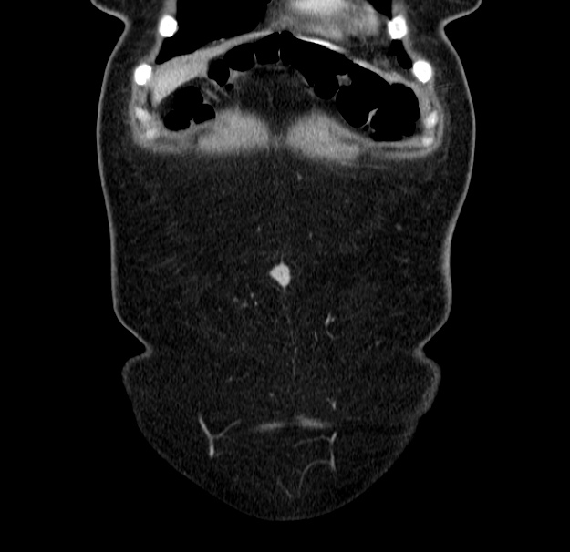 Choledocholithiasis on CT and MRI (Radiopaedia 24825-25087 C 6).jpg
