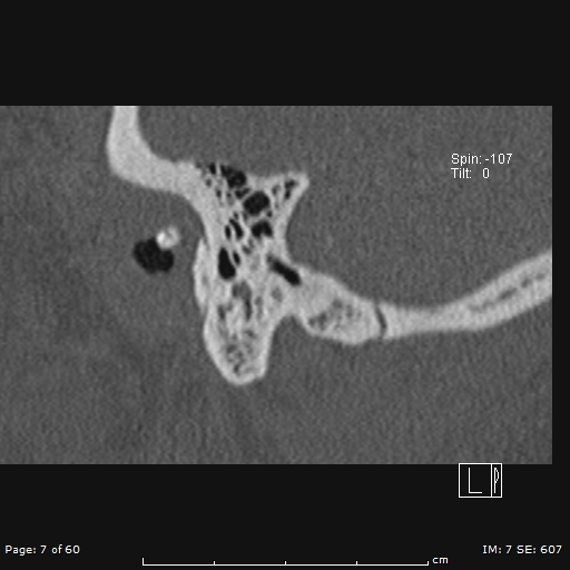 Cholesteatoma - external auditory canal (Radiopaedia 88452-105096 Sagittal bone window 7).jpg