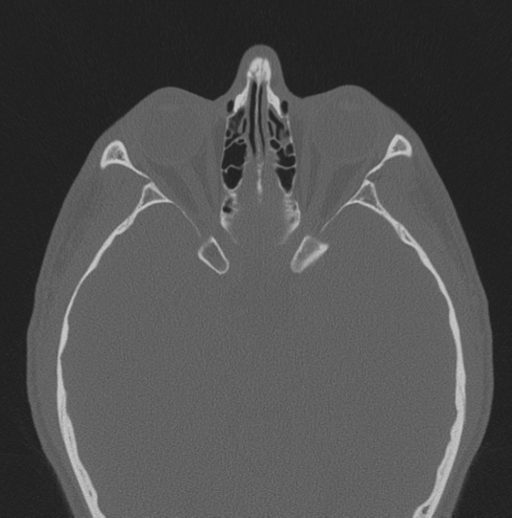 Chondrosarcoma (clivus) (Radiopaedia 46895-51425 Axial bone window 26).png