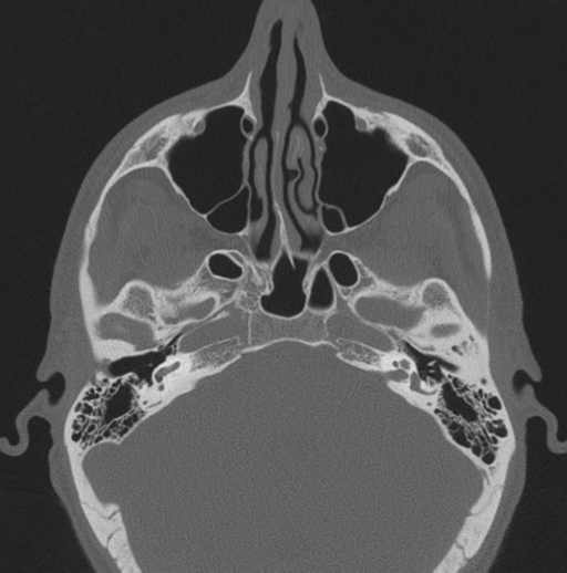 Chondrosarcoma (clivus) (Radiopaedia 46895-51425 Axial bone window 49).png