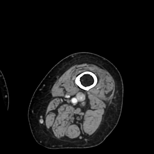 Chondrosarcoma - femur (Radiopaedia 64187-72954 Axial with contrast 1).jpg
