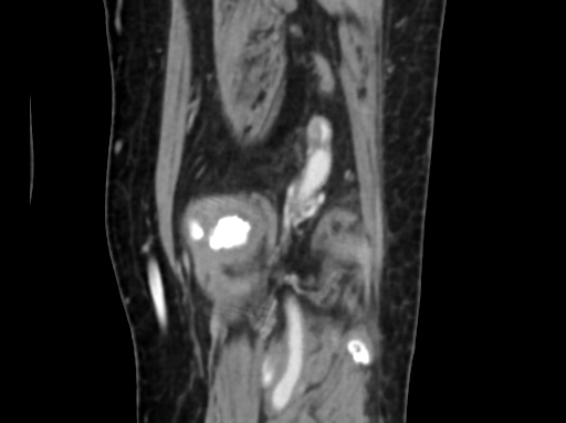 Chondrosarcoma - femur (Radiopaedia 64187-72954 C 49).jpg