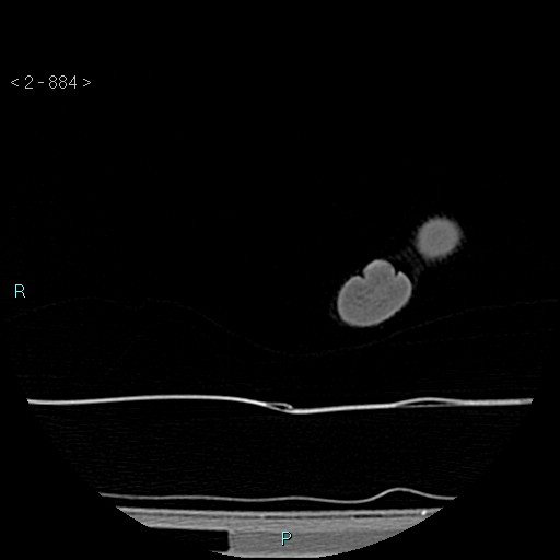 File:Chondrosarcoma - phalanx (Radiopaedia 69047-78812 Axial bone window 138).jpg