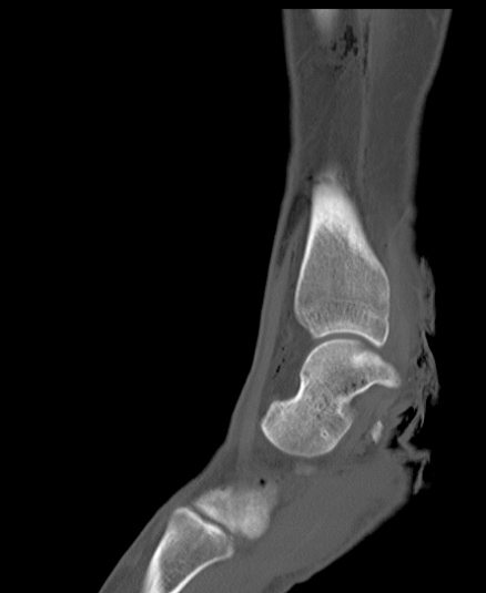 Chopart fracture (Radiopaedia 35347-36851 Sagittal bone window 23).jpg