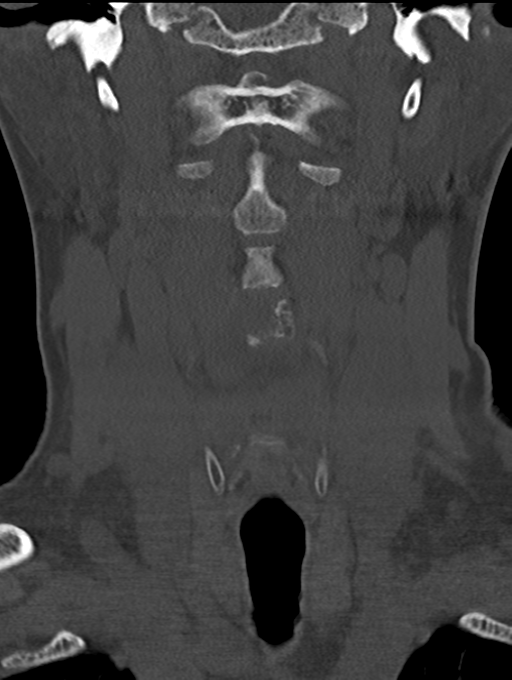 Chordoma (C4 vertebra) (Radiopaedia 47561-52188 Coronal bone window 11).png