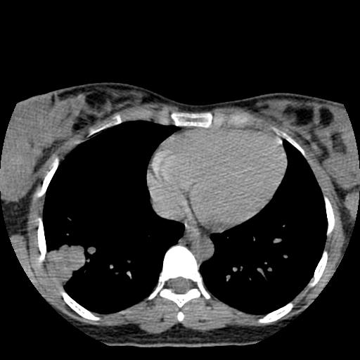 File:Choriocarcinoma of ovary with cerebral and pulmonary metastases (Radiopaedia 25983-26119 Axial non-contrast 10).jpg