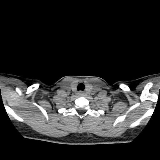File:Choriocarcinoma of ovary with cerebral and pulmonary metastases (Radiopaedia 25983-26119 Axial non-contrast 71).jpg
