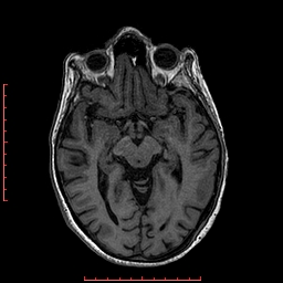 Choroid plexus xanthogranuloma (Radiopaedia 67843-77270 Axial T1 97).jpg
