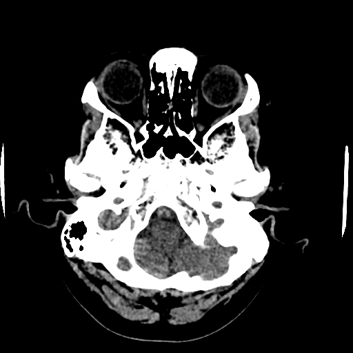 File:Choroid plexus xanthogranulomas (Radiopaedia 51621-57408 Axial non-contrast 13).jpg