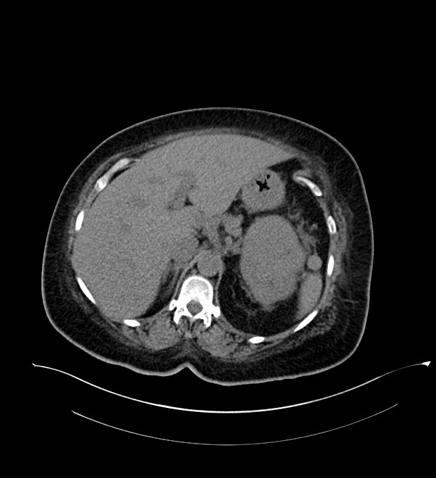 Chromophobe renal cell carcinoma (Radiopaedia 84239-99519 Axial non-contrast 52).jpg