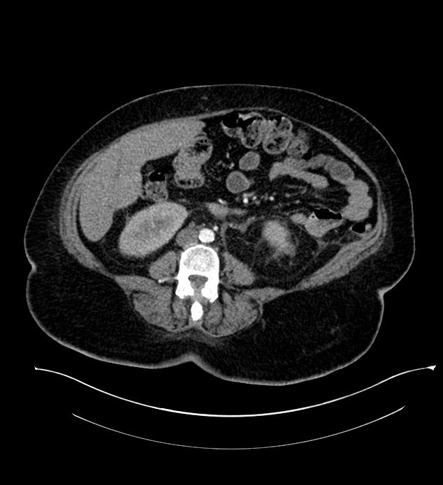 Chromophobe renal cell carcinoma (Radiopaedia 84239-99519 B 68).jpg