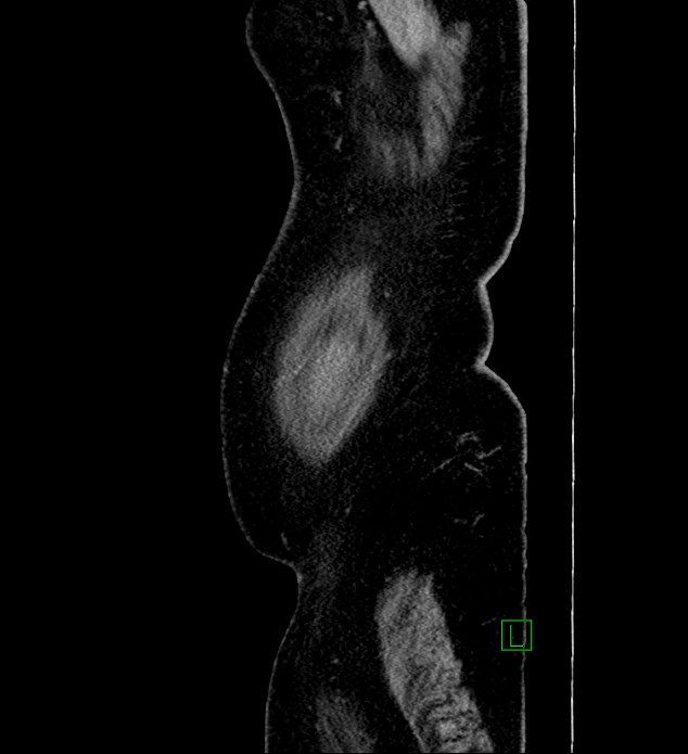 Chromophobe renal cell carcinoma (Radiopaedia 84239-99519 G 113).jpg