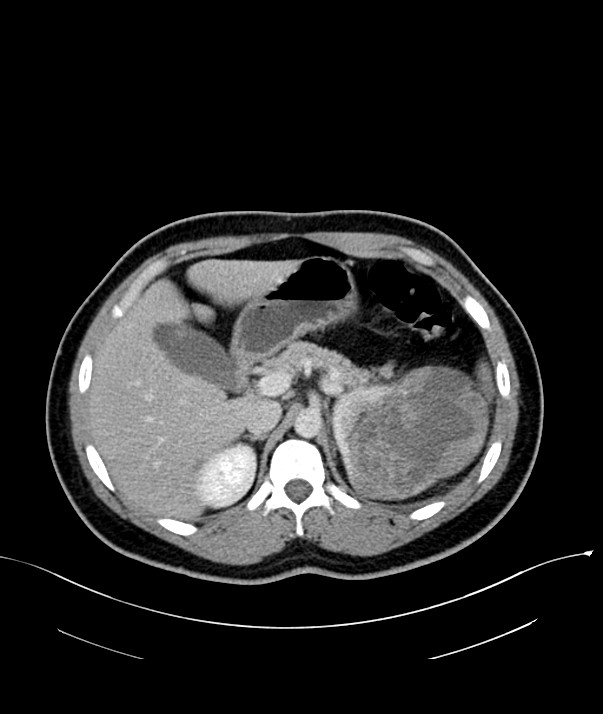 Chromophobe renal cell carcinoma (Radiopaedia 84255-99542 F 25).jpg