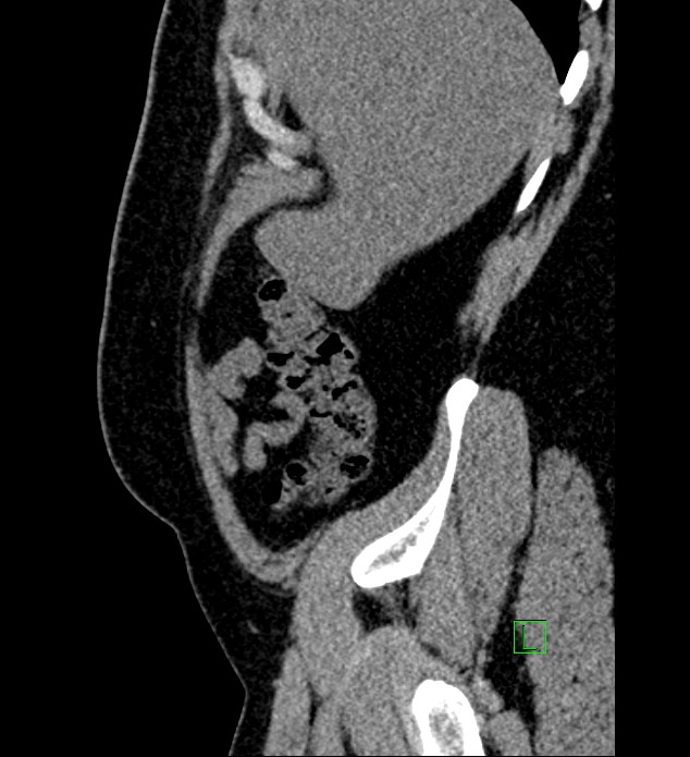 Chromophobe renal cell carcinoma (Radiopaedia 84286-99573 C 162).jpg