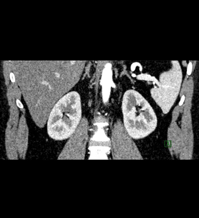 Chromophobe renal cell carcinoma (Radiopaedia 84286-99573 E 54).jpg