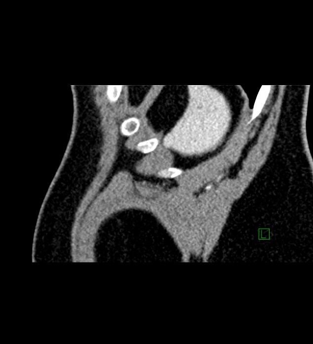 Chromophobe renal cell carcinoma (Radiopaedia 84286-99573 F 3).jpg