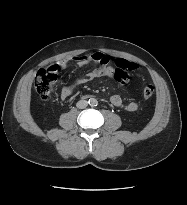 Chromophobe renal cell carcinoma (Radiopaedia 86879-103083 D 82).jpg