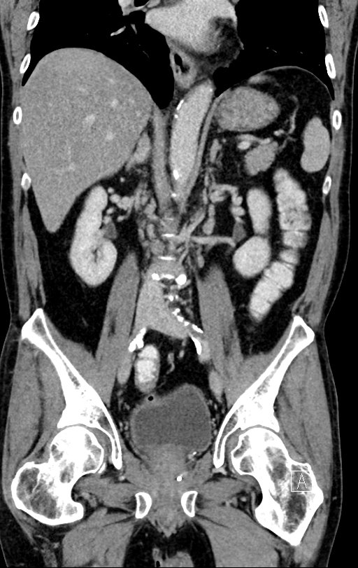 Chronic appendicitis complicated by appendicular abscess, pylephlebitis and liver abscess (Radiopaedia 54483-60700 C 47).jpg