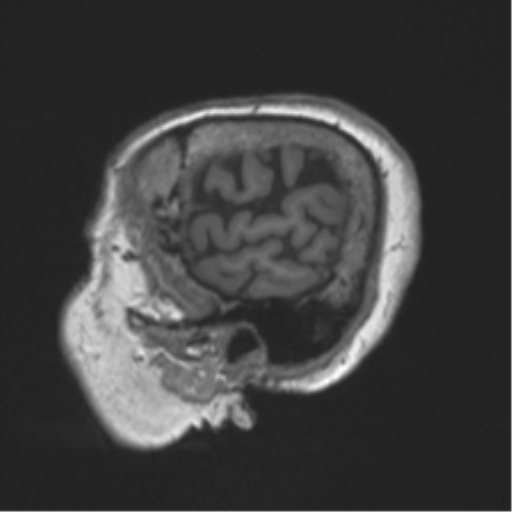 Chronic hypertensive encephalopathy (Radiopaedia 39993-42482 Sagittal T1 16).png