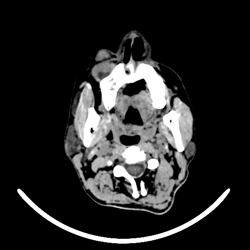 File:Chronic invasive fungal sinusitis with intraorbital and intracranial extension (Radiopaedia 56387-63046 Axial non-contrast 24).jpg