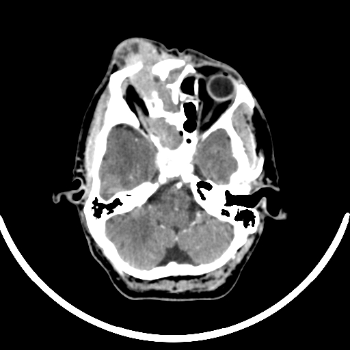 Chronic invasive fungal sinusitis with intraorbital and intracranial extension (Radiopaedia 56387-63046 B 106).jpg