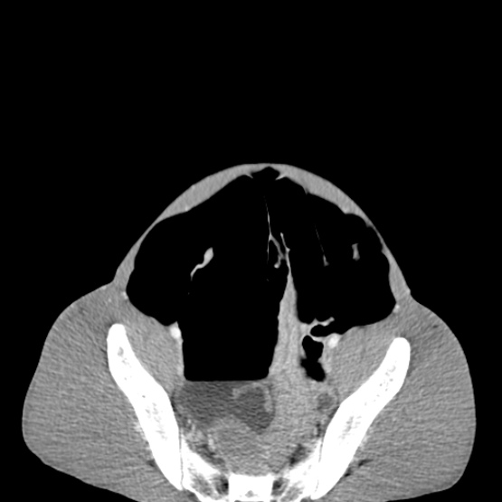 Chronic large bowel pseudo-obstruction (Radiopaedia 43181-46492 A 140).jpg