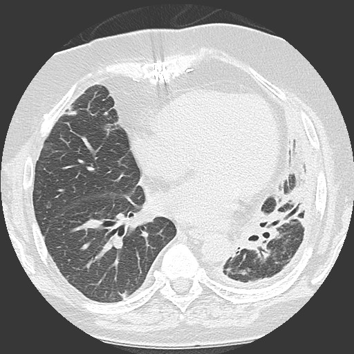File:Chronic lung allograft dysfunction - restrictive form (Radiopaedia 60595-68316 Axial lung window 42).jpg