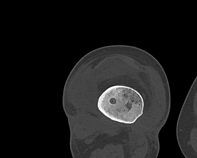 Chronic ostemyelitis of the femur with long sinus tract (Radiopaedia 74947-85982 Axial bone window 183).jpg