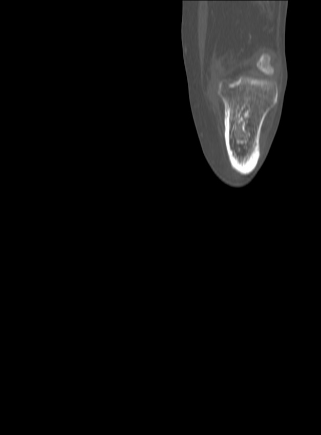 Chronic osteomyelitis - tibia (with sequestrum) (Radiopaedia 73273-84090 Coronal non-contrast 34).jpg